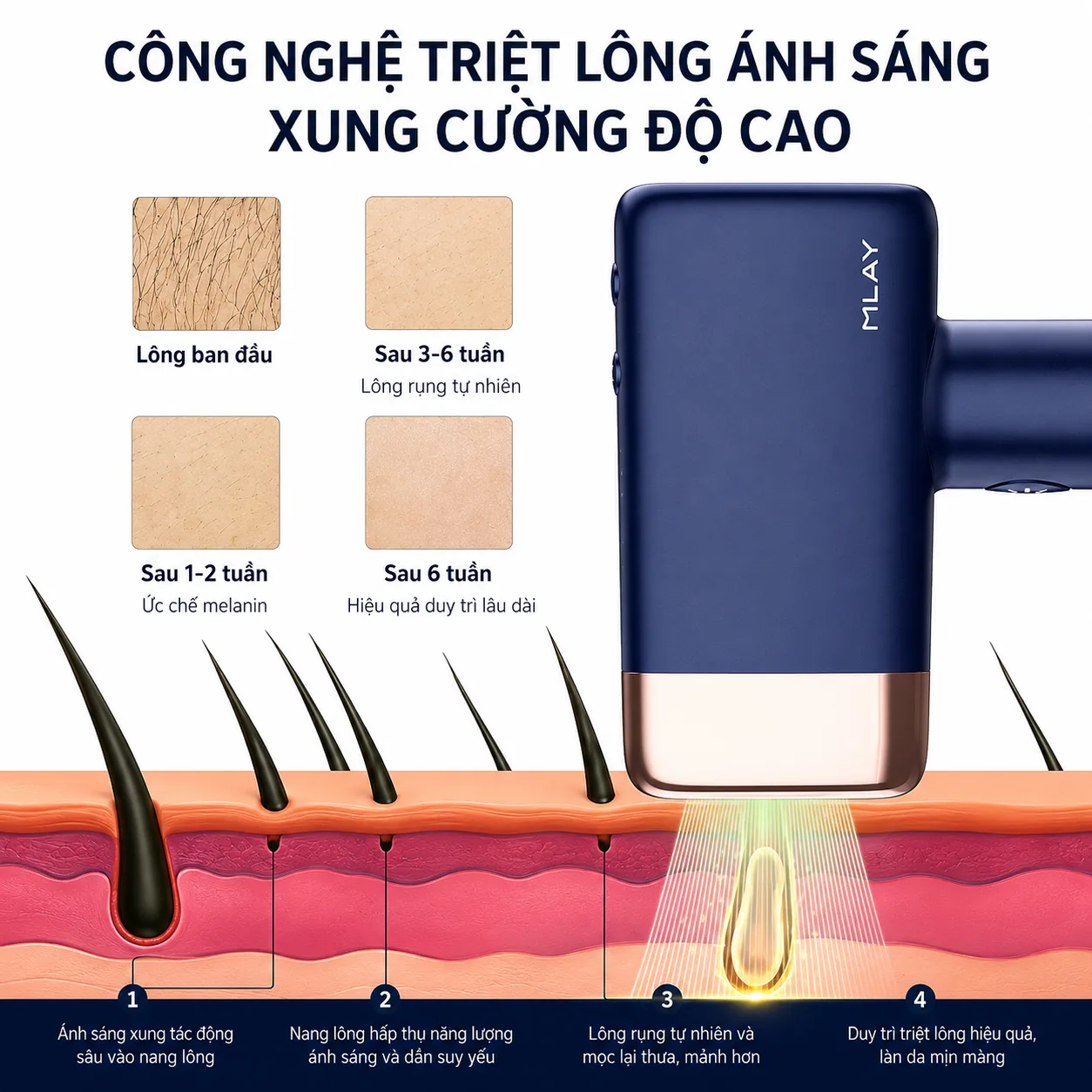 Công nghệ triệt lông ánh sáng xung cường độ cao của MLay T14